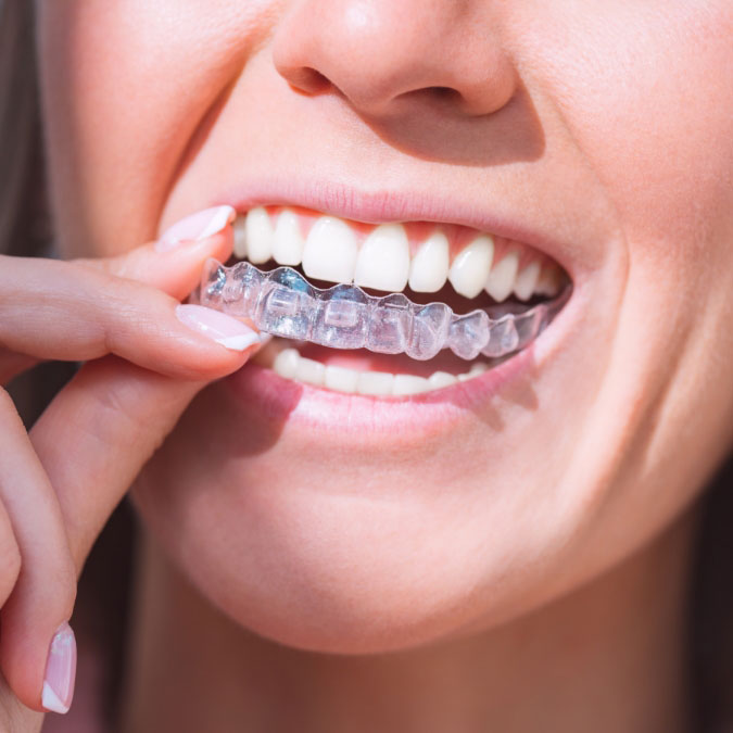 iSmile Orthodontics patient putting in her Invisalign clear aligners